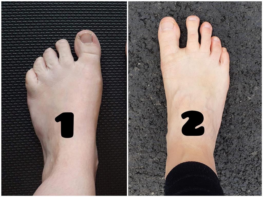 What is my Foot Type? | Bose Nogice