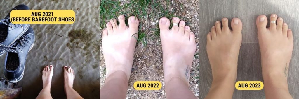 A Year In Barefoot Shoes: The Astonishing Before And After Results